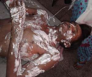 Gas leak, five injured in cylinder blast