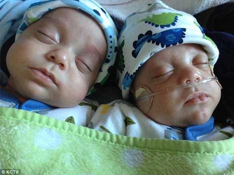 women who delivered twins on a gap of 39 days