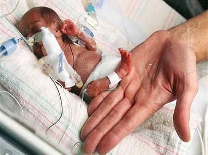 women who delivered twins on a gap of 39 days