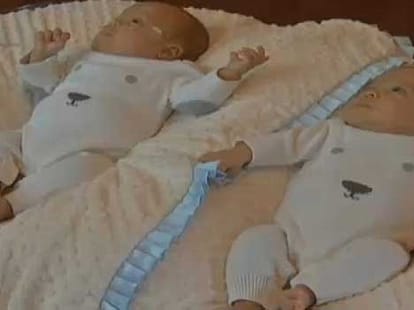 women who delivered twins on a gap of 39 days