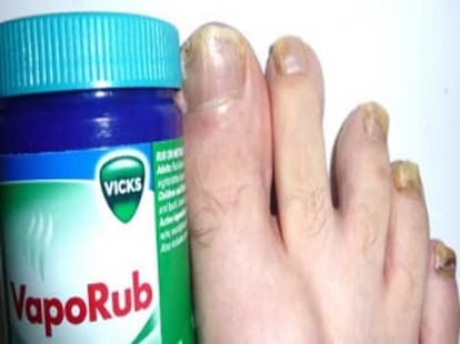 surprising uses of vicks vapor rub