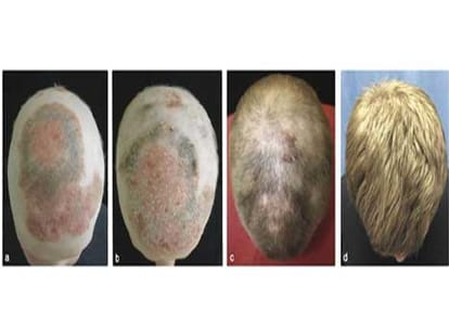 arthritis drug can cure baldness