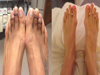 women getting their toes cut to wear heels 