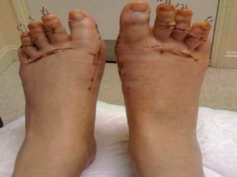 women getting their toes cut to wear heels 