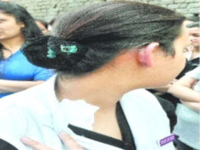 A hostel warden suspended in hot pulse throw case at IGMC