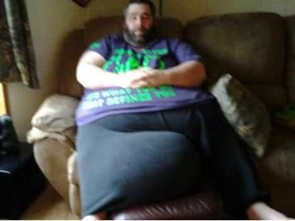man whose scrotum weighs 45 kilos