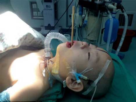 toddler gets chopsticks stuch in brain via mouth