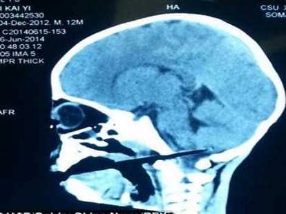 toddler gets chopsticks stuch in brain via mouth