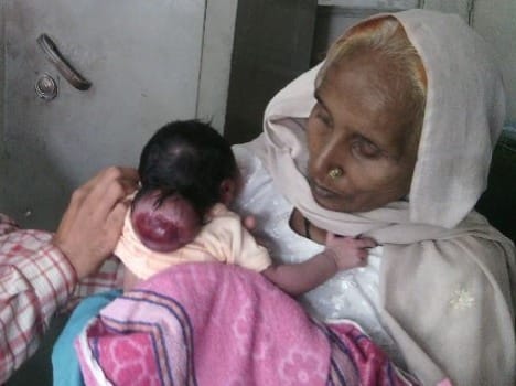 neural defect disease in born child