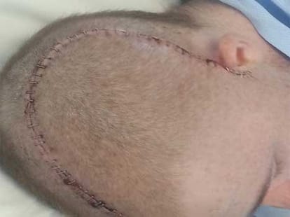 doctors put part of skull in stomach