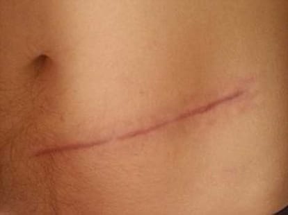 doctors put part of skull in stomach