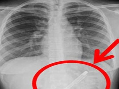 fountain pen gets stuck inside girl's stomach