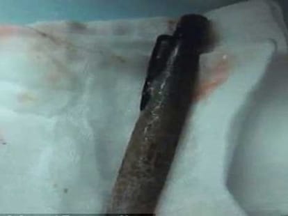 fountain pen gets stuck inside girl's stomach