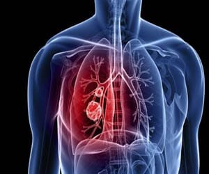 two successful cancer surgery at SMGS