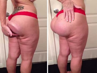 bum implant surgery went wrong