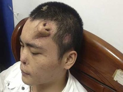 nose grown on back