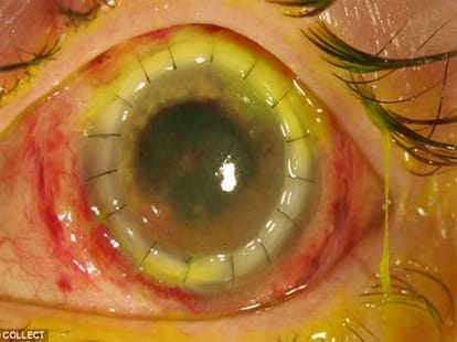 girl becomes blind wearing infected contact lens