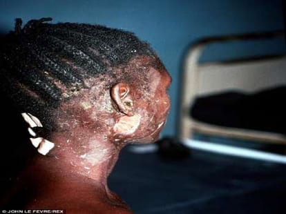 alert in india over Ebola virus