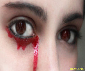 woman suffering from rare disease; sheds 'blood tears'