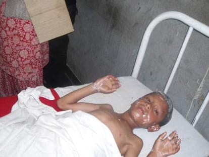 student scorched due to gas leakage died in igmc hospital