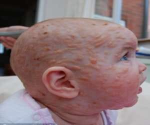 girl develops horrific rashes when she is sad