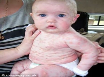 girl develops horrific rashes when she is sad