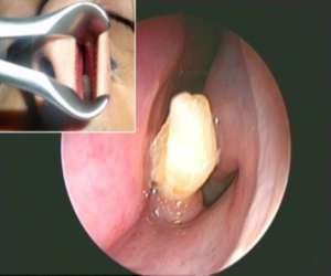 man with teeth grown inside nose