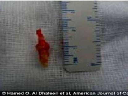 man with teeth grown inside nose