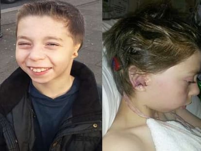 boy who got ears from his ribs