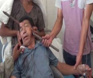 rod stuck inside man's face