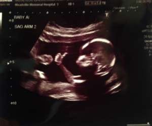 baby who shows thumps up during ultrasound