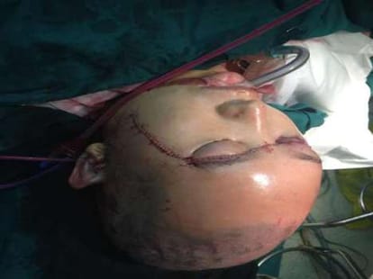 woman's head scalped abdly after an accident