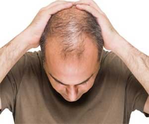 7 Reasons for Baldness in Males