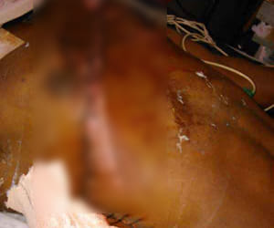 chest burst in the accident , doctors gave new life