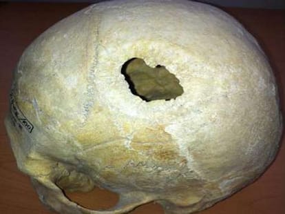 brain surgery 2300 years ago baffles scientists 