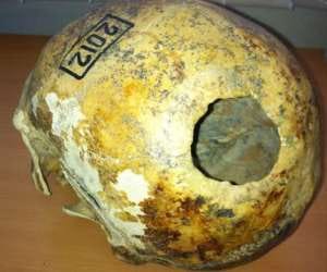 brain surgery 2300 years ago baffles scientists 