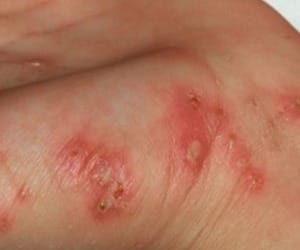 know here about scrub typhus and its treatment
