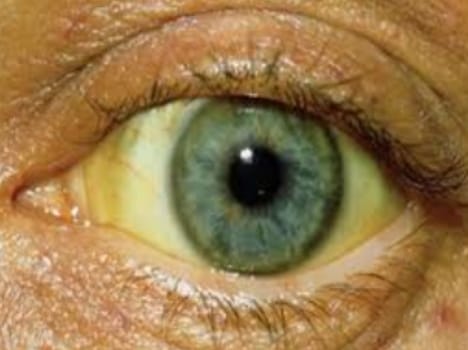 The death of the young man cause of jaundice