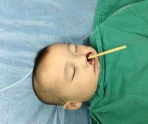 toddlers rams chopstick through his nose to brain