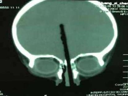 toddlers rams chopstick through his nose to brain