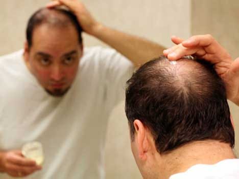 baldness link up with health