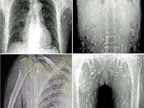fish lover's entire body riddled with tapeworms