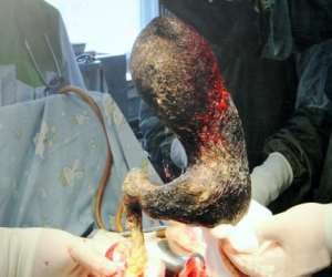 girl found with 4 kilo hairball inside stomach