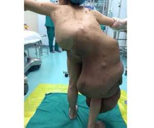 tumour covered all over back and leg