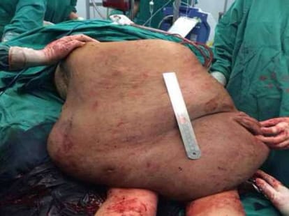 tumour covered all over back and leg