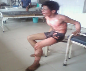 Mentally weak person travelling upon train burn by hi-tension wire.
