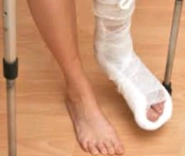 Broken right leg and plaster on left