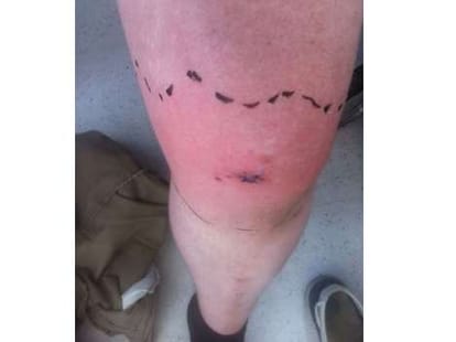 man sues hospital for not detecting teeth in his knee