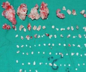 doctors removed 202 ‘teeth’ from a seven year old girl's mouth