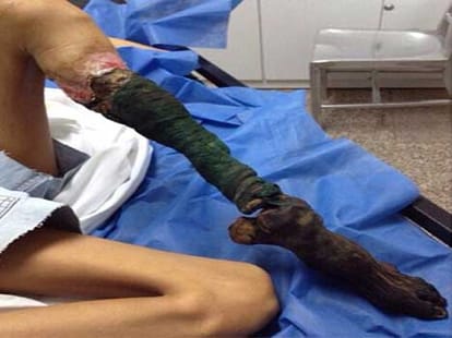 legs shrivels and turns black after snake bite